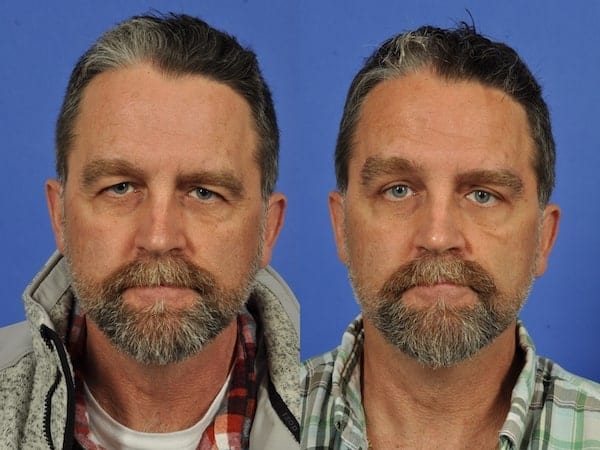 Brow Lift Before and After Male