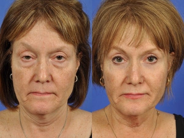 Brow Lift Before and After Woman