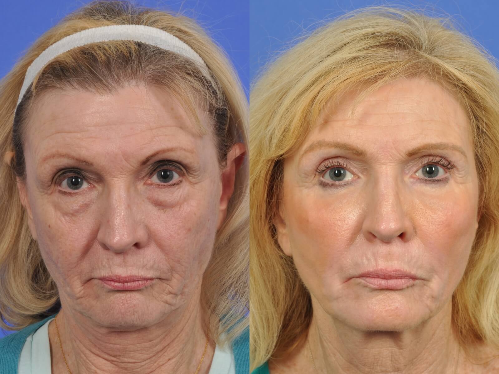 taller Específicamente Mierda Laser Skin Resurfacing Before and After | W Cosmetic Surgery
