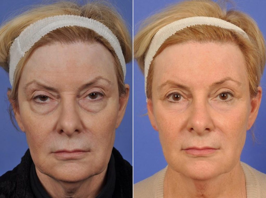 Upper Blepharoplasty Before & After With W Cosmetic Surgery