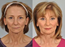 The Micromidfacelift