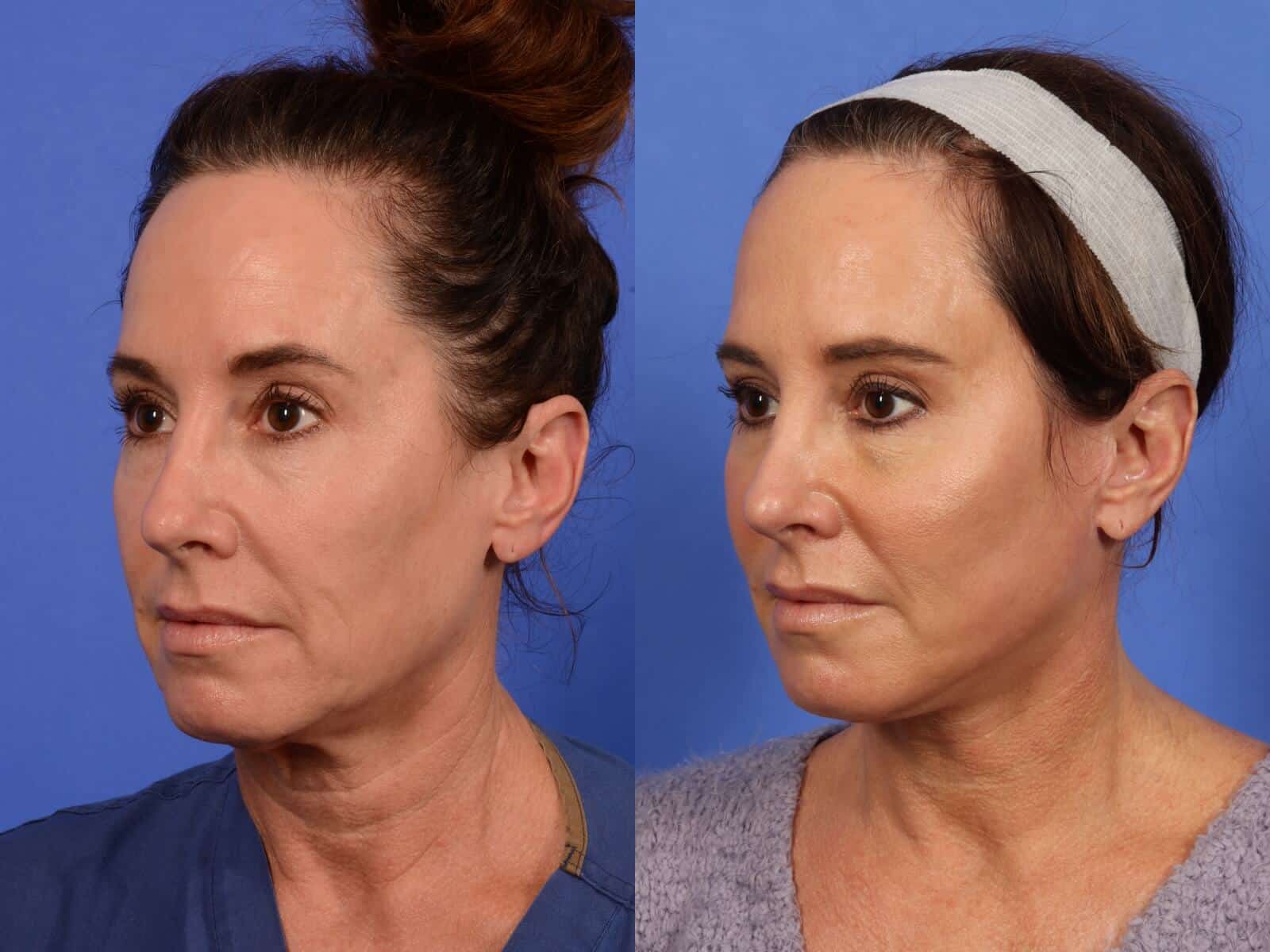 How to look younger: 60-year-old transforms jowls with filler