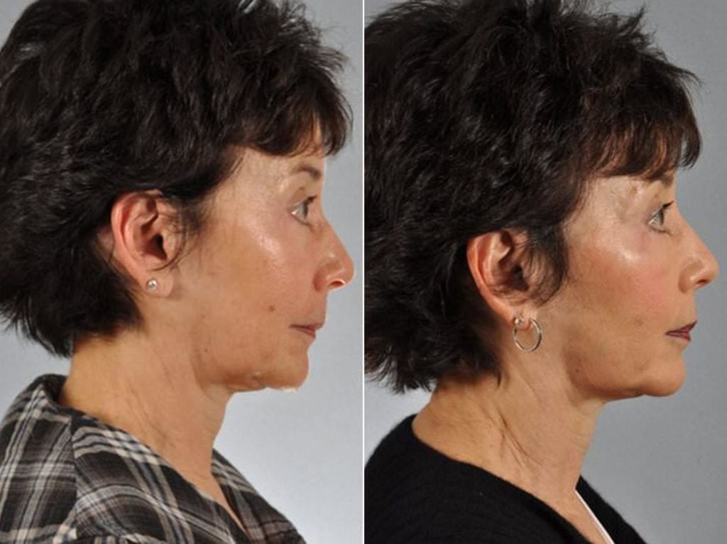 72 year old woman with Dypost before and after