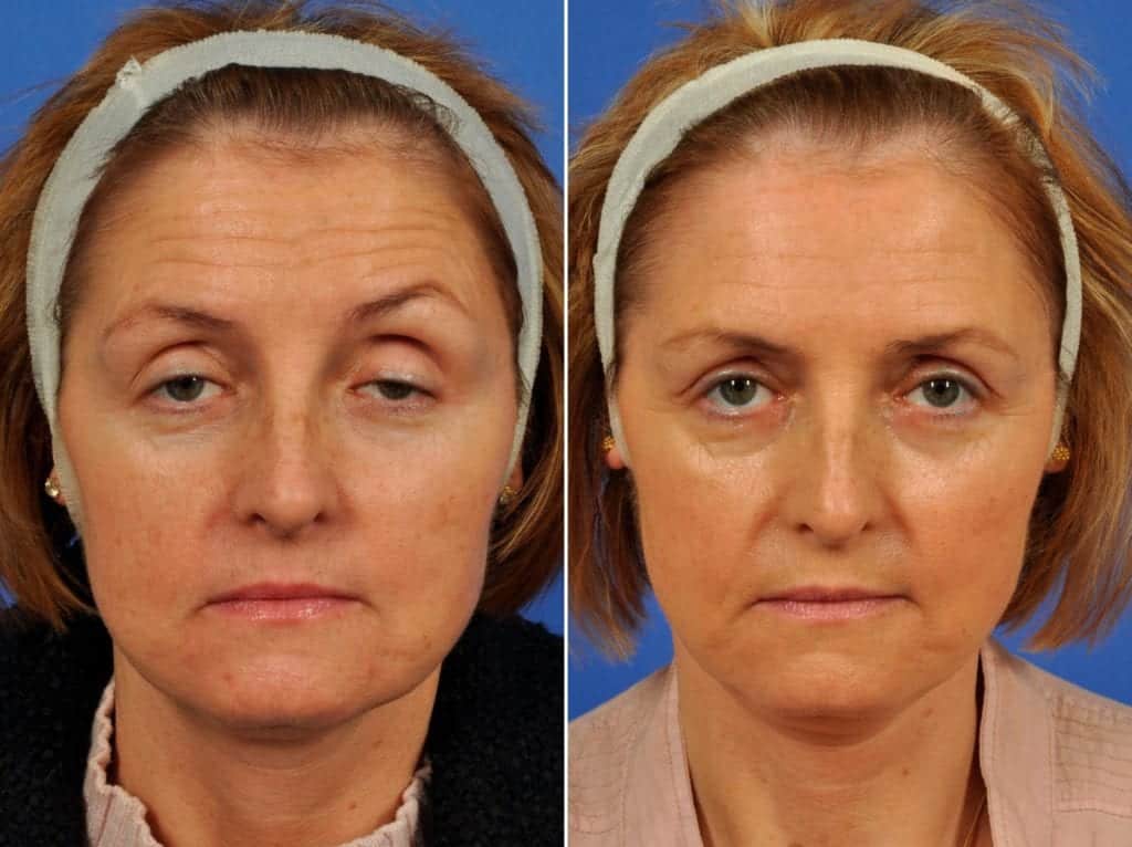 Ptosis Droopy Eyelid Surgery Before And After Pictures