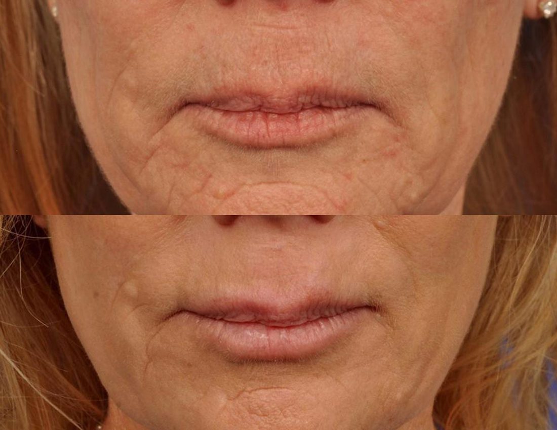 Microneedling Before After 4 1024x191 1 1 