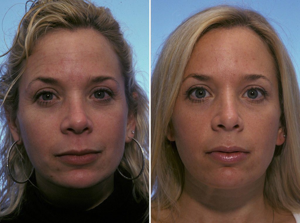 34 year old woman with Botox before and after