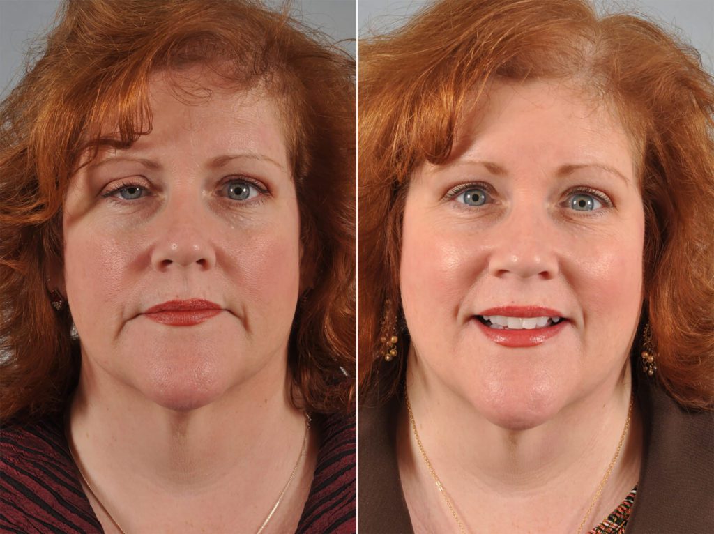 Ptosis Droopy Eyelid Surgery Before and After Pictures