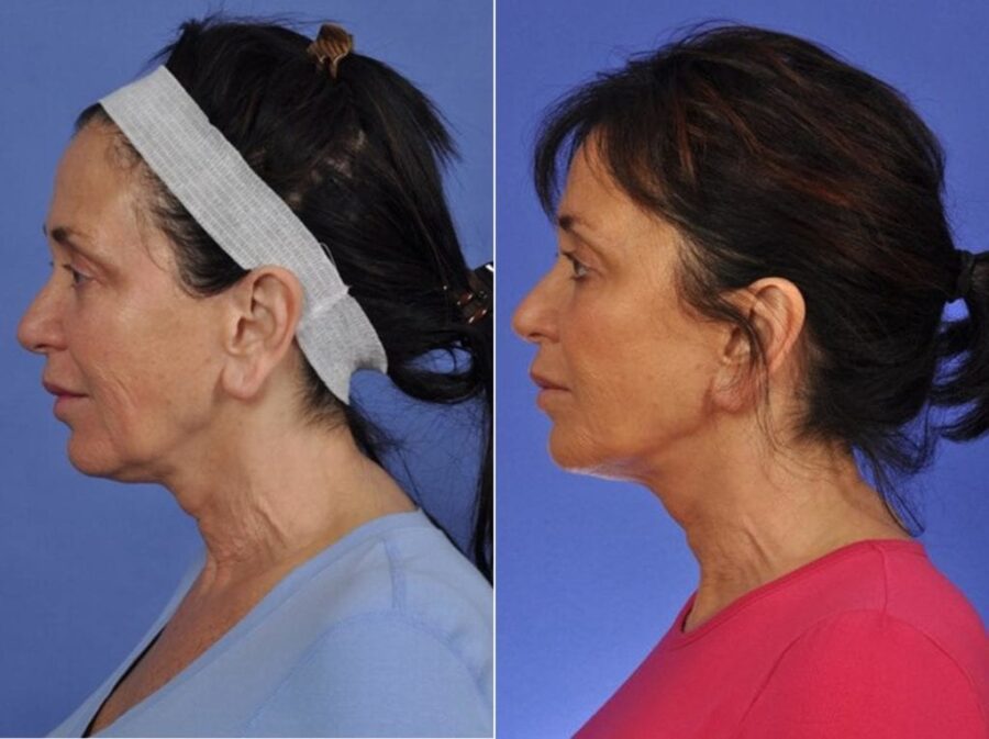Thermitight Before And After Pictures W Cosmetic Surgery