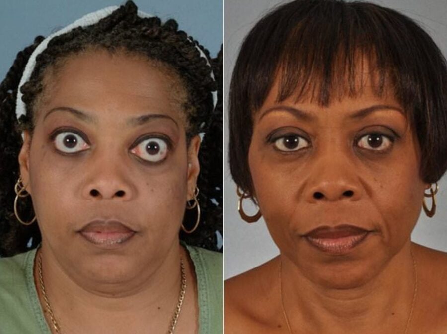 Thyroid Eye Disease Before and After W Cosmetic Surgery