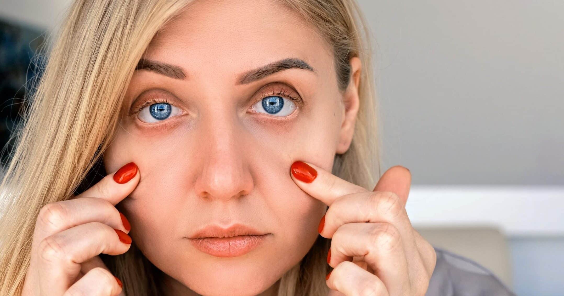 Dark Circles and Eye Bags - Why they occur and Holistic remedies