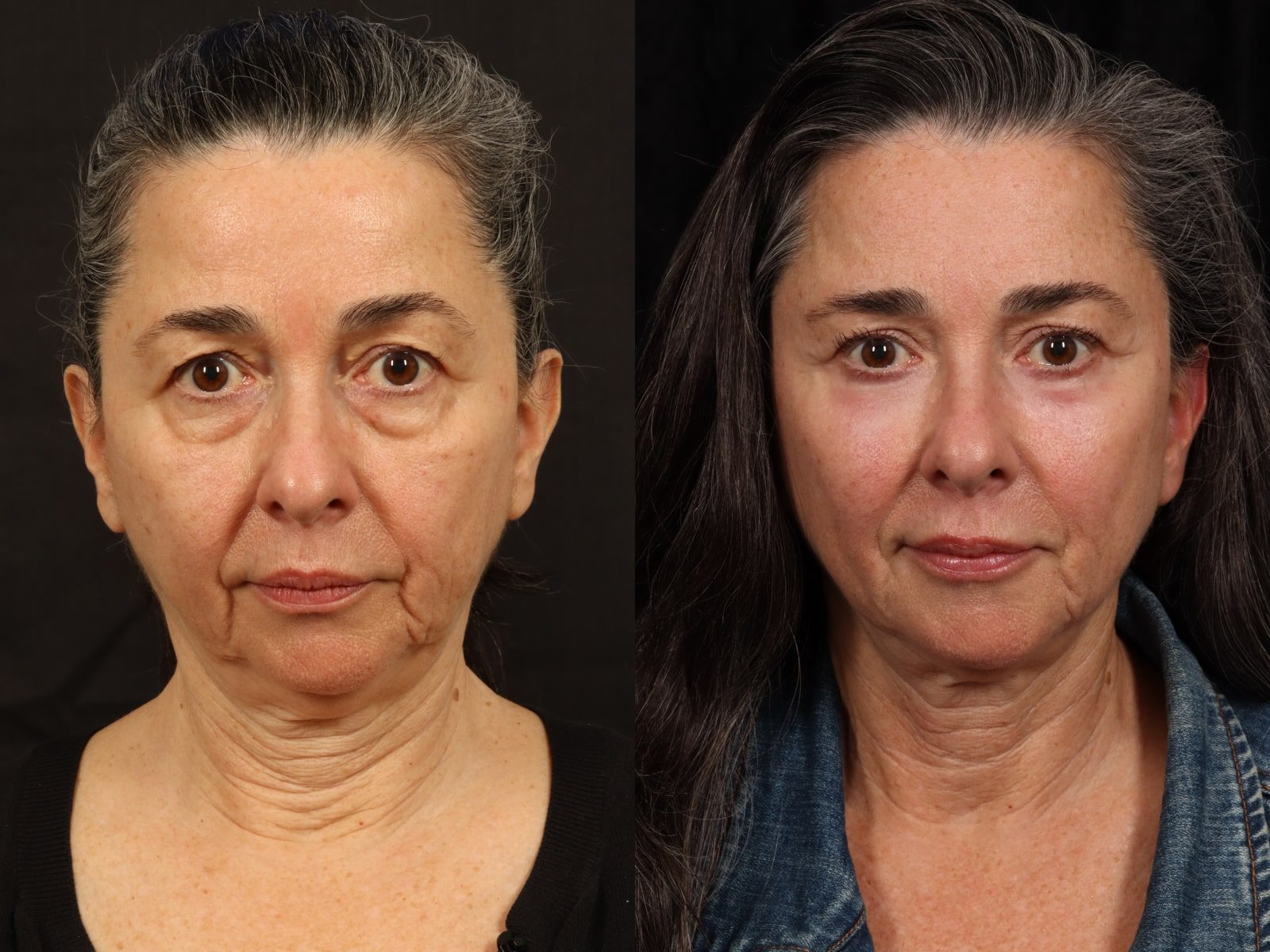 Mid Facelift Before and After Photos