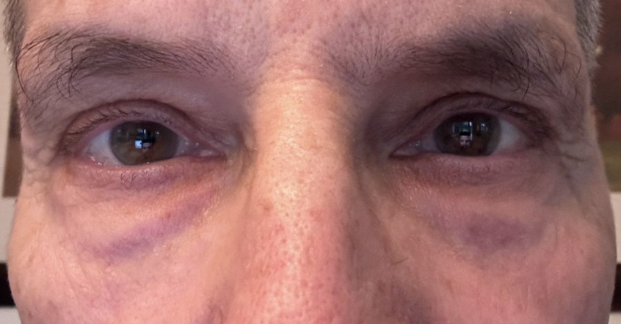 Hollowing of under eyes